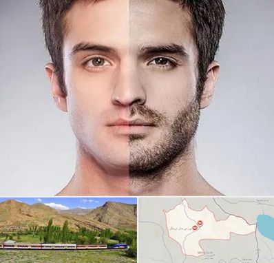 کاشت ریش و سبیل در خاش