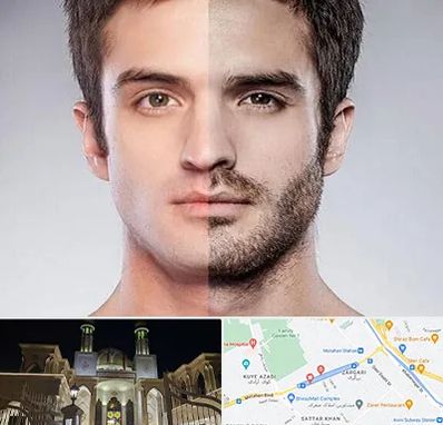 کاشت ریش و سبیل در زرگری شیراز