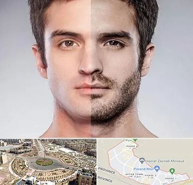 کاشت ریش و سبیل در پرند