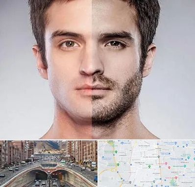 کاشت ریش و سبیل در منطقه 10 تهران