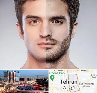 کاشت ریش و سبیل در صادقیه