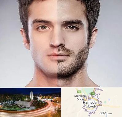 کاشت ریش و سبیل در همدان