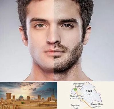 کاشت ریش و سبیل در یزد