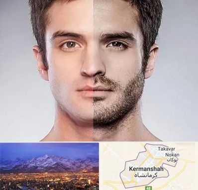 کاشت ریش و سبیل در کرمانشاه