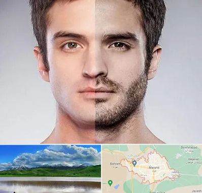 کاشت ریش و سبیل در مرند