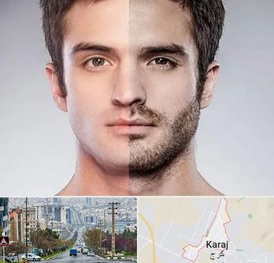 کاشت ریش و سبیل در گوهردشت