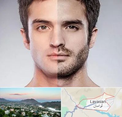 کاشت ریش و سبیل در لواسان