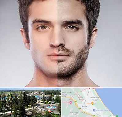 کاشت ریش و سبیل در رودسر