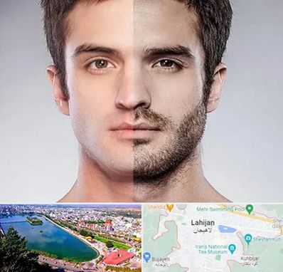 کاشت ریش و سبیل در لاهیجان