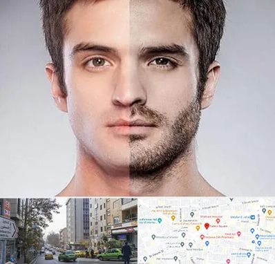 کاشت ریش و سبیل در فاطمی