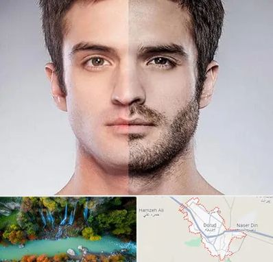 کاشت ریش و سبیل در دورود