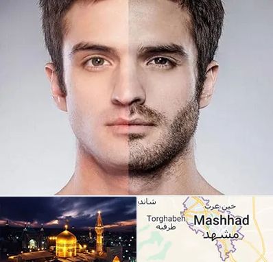 کاشت ریش و سبیل در مشهد