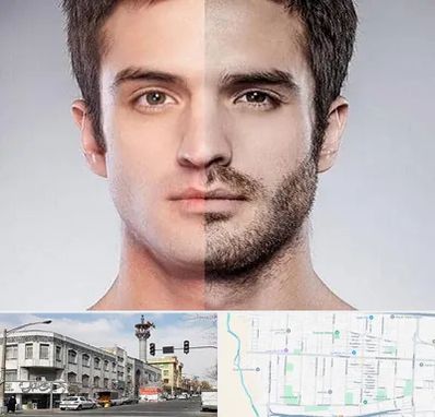 کاشت ریش و سبیل در 17شهریور