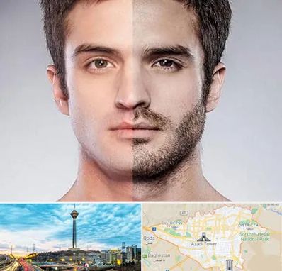 کاشت ریش و سبیل در تهران