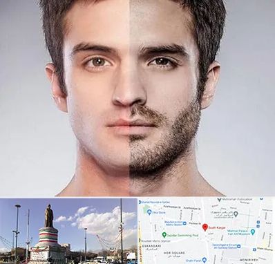 کاشت ریش و سبیل در کارگر جنوبی