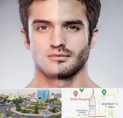 کاشت ریش و سبیل در ونک