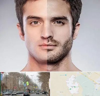 کاشت ریش و سبیل در نظرآباد کرج