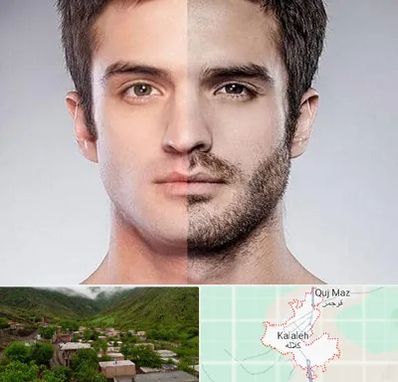 کاشت ریش و سبیل در کلاله