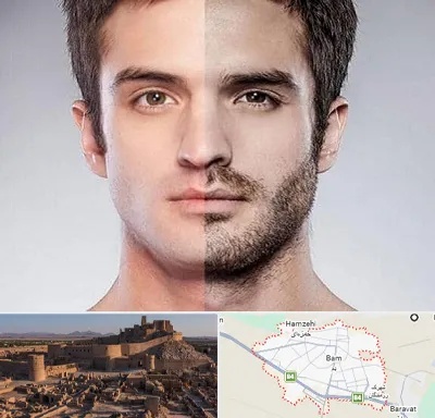 کاشت ریش و سبیل در بم