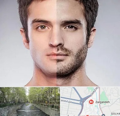 کاشت ریش و سبیل در زرگنده