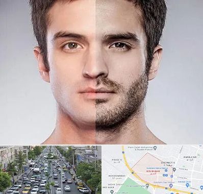 کاشت ریش و سبیل در گلشهر کرج