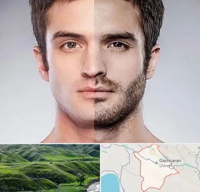 کاشت ریش و سبیل در گچساران