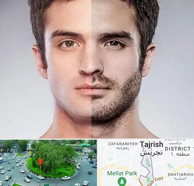 کاشت ریش و سبیل در تجریش