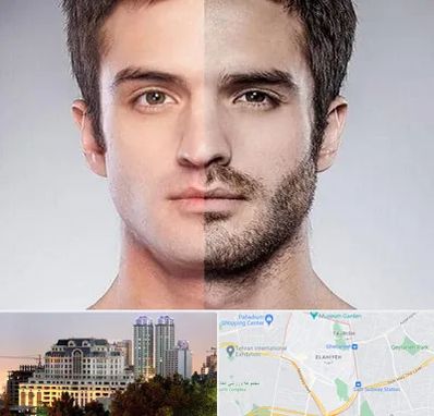 کاشت ریش و سبیل در فرشته