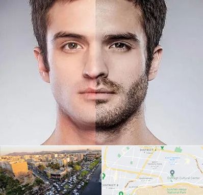 کاشت ریش و سبیل در تهرانپارس