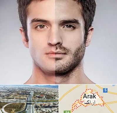 کاشت ریش و سبیل در اراک