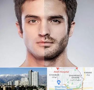 کاشت ریش و سبیل در شهرک غرب تهران