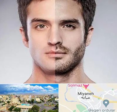 کاشت ریش و سبیل در میانه