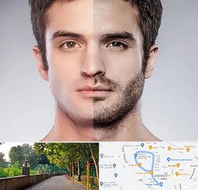 کاشت ریش و سبیل در فلکه گاز رشت