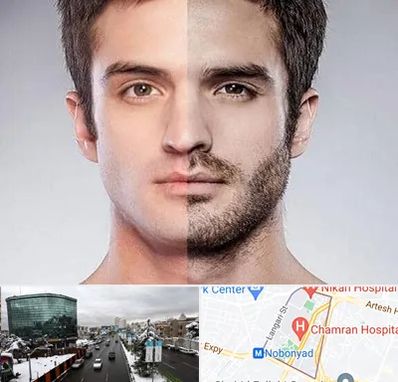 کاشت ریش و سبیل در اقدسیه