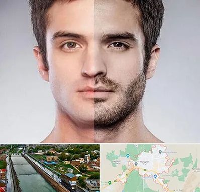 کاشت ریش و سبیل در مراغه