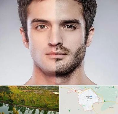 کاشت ریش و سبیل در بهبهان