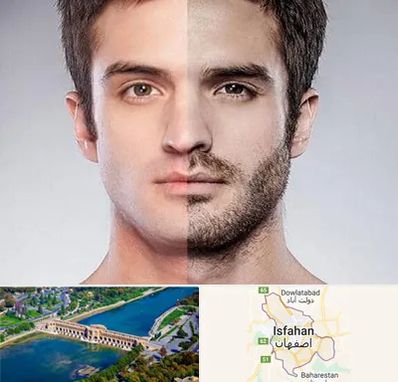 کاشت ریش و سبیل در اصفهان