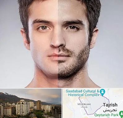 کاشت ریش و سبیل در زعفرانیه