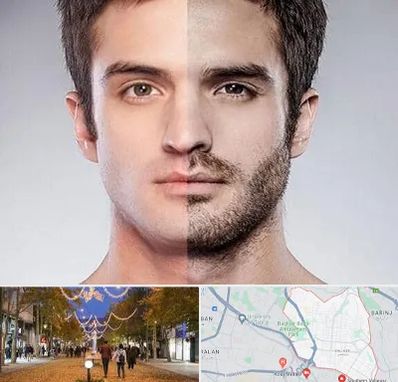 کاشت ریش و سبیل در ولیعصر ارومیه