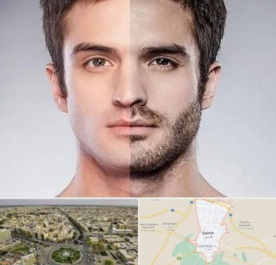 کاشت ریش و سبیل در قزوین