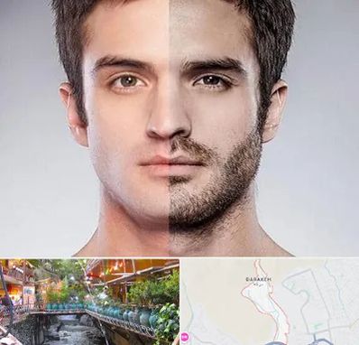 کاشت ریش و سبیل در درکه