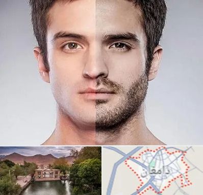 کاشت ریش و سبیل در دامغان