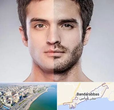 کاشت ریش و سبیل در بندرعباس