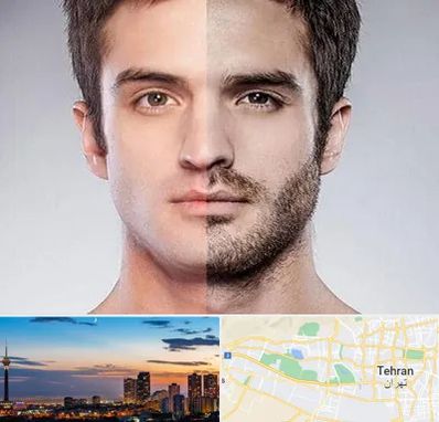 کاشت ریش و سبیل در غرب تهران