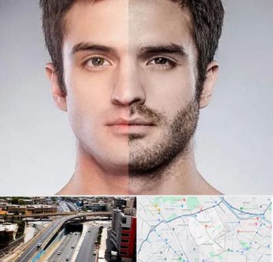 کاشت ریش و سبیل در ستارخان شیراز