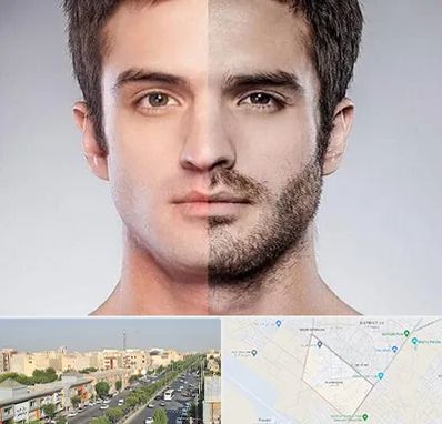 کاشت ریش و سبیل در کیانمهر کرج