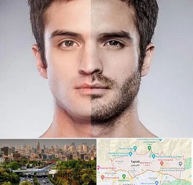 کاشت ریش و سبیل در منطقه 1 تهران