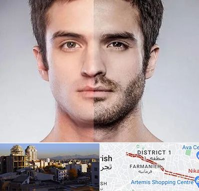 کاشت ریش و سبیل در فرمانیه