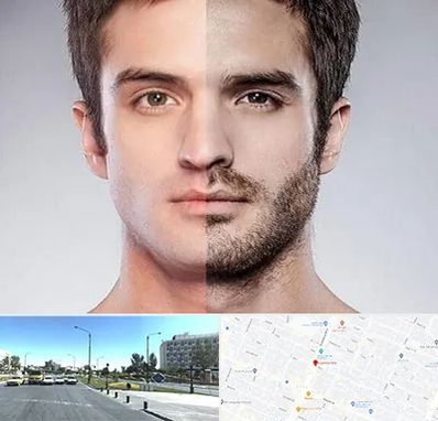 کاشت ریش و سبیل در بلوار کلاهدوز مشهد