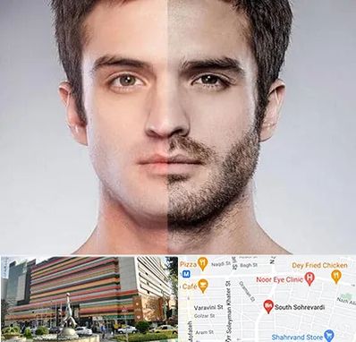 کاشت ریش و سبیل در سهروردی